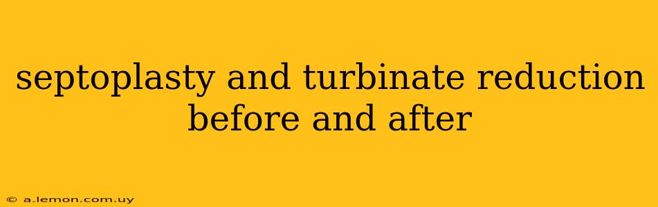 septoplasty and turbinate reduction before and after